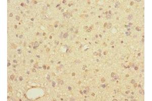 Immunohistochemistry of paraffin-embedded human glioma using ABIN7158053 at dilution of 1:100 (LINGO1 Antikörper  (AA 42-240))