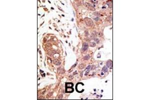 Formalin-fixed and paraffin-embedded human cancer tissue reacted with the primary antibody, which was peroxidase-conjugated to the secondary antibody, followed by AEC staining. (SENP1 Antikörper  (N-Term))