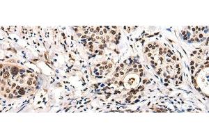 Immunohistochemistry of paraffin-embedded Human cervical cancer tissue using USP6NL Polyclonal Antibody at dilution of 1:30(x200) (USP6NL Antikörper)