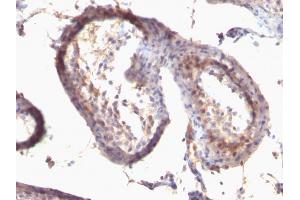 Formalin-fixed, paraffin-embedded human Testicular Carcinoma stained with TGF alpha Monoclonal Antibody (SPM542) (TGFA Antikörper  (AA 34-43))