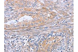 The image on the left is immunohistochemistry of paraffin-embedded Human cervical cancer tissue using ABIN7189998(BOD1 Antibody) at dilution 1/30, on the right is treated with synthetic peptide. (BOD1 Antikörper)