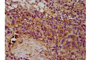 IHC image of ABIN7151818 diluted at 1:300 and staining in paraffin-embedded human ovarian cancer performed on a Leica BondTM system. (EPX Antikörper  (AA 140-300))