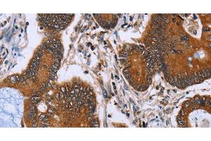 Immunohistochemistry of paraffin-embedded Human colon cancer tissue using IHH Polyclonal Antibody at dilution 1:30 (Indian Hedgehog Antikörper)