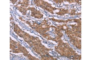 Immunohistochemistry of Human liver cancer using HRH3 Polyclonal Antibody at dilution of 1:40