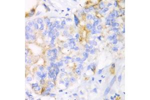 Immunohistochemistry of paraffin-embedded human liver cancer using CHIA antibody (ABIN6292576) at dilution of 1:100 (40x lens).