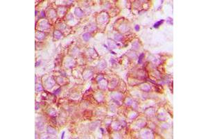 Immunohistochemical analysis of CRK staining in human breast cancer formalin fixed paraffin embedded tissue section. (Crk Antikörper  (Center))