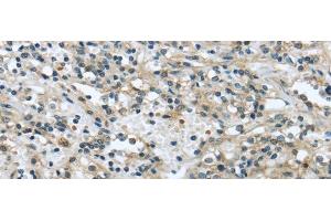 Immunohistochemistry of paraffin-embedded Human prostate cancer tissue using VPS4A Polyclonal Antibody at dilution 1:40