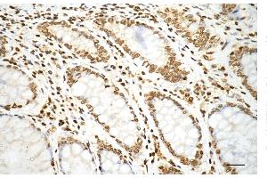 Immunohistochemistry was performed on paraffin-embedded human sigmoid colon carcinoma using histone H3 (mono methyl K79) antibody (ABIN7798961), 1:200). (Rekombinanter Histone 3 Antikörper  (H3K79me1))