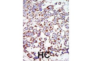 Formalin-fixed and paraffin-embedded human hepatocellular carcinoma tissue reacted with the MAP3K7 polyclonal antibody , which was peroxidase-conjugated to the secondary antibody, followed by AEC staining.