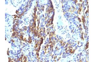 Formalin-fixed, paraffin-embedded human Tongue stained with Melanoma Monoclonal Antibody (KBA. (Melanoma Associated Antigen (KBA.62) Antikörper)
