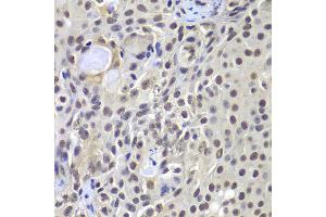 Immunohistochemistry of paraffin-embedded human well-differentiated squamous skin carcinoma using PRKDC antibody at dilution of 1:100 (x400 lens). (PRKDC Antikörper)