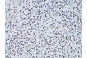Immunohistochemistry of paraffin-embedded human adenomyosis using LMNB2 Antibody (ABIN5973877) at dilution of 1/100 (40x lens). (Lamin B2 Antikörper)