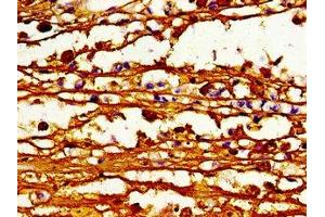 Immunohistochemistry of paraffin-embedded human melanoma using ABIN7163123 at dilution of 1:100 (ABCB4 Antikörper  (AA 530-693))