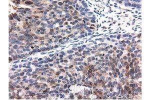 Immunohistochemical staining of paraffin-embedded Carcinoma of Human kidney tissue using anti-QPRT mouse monoclonal antibody. (QPRT Antikörper)