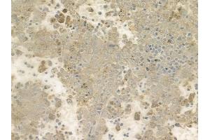 ABIN6257016 and ABIN6274443 at 1/100 staining human melanoma by IHC-P.