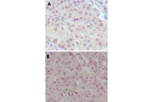 Immunohistochemical analysis of paraffin-embedded human lung cancer (A) and esophagus cancer (B), showing nuclear weak staining with DAB staining using MLL monoclonal antibody, clone 10F8D7 . (MLL/KMT2A Antikörper)