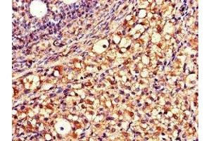 Immunohistochemistry of paraffin-embedded human ovarian cancer using ABIN7149920 at dilution of 1:100 (QDPR Antikörper  (AA 2-244))