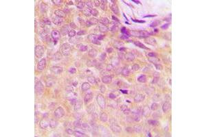 Immunohistochemical analysis of UBA5 staining in human breast cancer formalin fixed paraffin embedded tissue section.