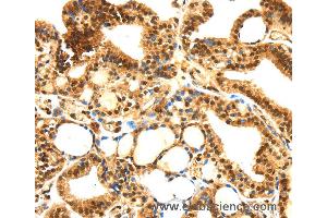 Immunohistochemistry of Human thyroid cancer using SERPINB1 Polyclonal Antibody at dilution of 1:30