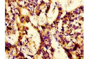 Immunohistochemistry of paraffin-embedded human gastric cancer using ABIN7158434 at dilution of 1:100 (LBP Antikörper  (AA 304-414))