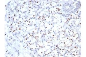 IHC analysis of formalin-fixed, paraffin-embedded human kidney cancer. (Rekombinanter CDKN1C Antikörper)