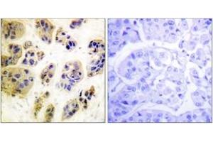 Immunohistochemistry analysis of paraffin-embedded human breast carcinoma, using CBL (Phospho-Tyr700) Antibody. (CBL Antikörper  (pTyr700))