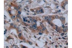 Detection of C2CD3 in Human Pancreatic cancer Tissue using Polyclonal Antibody to C2 Calcium Dependent Domain Containing Protein 3 (C2CD3) (C2CD3 Antikörper  (AA 1432-1647))