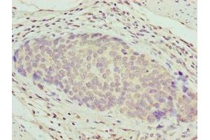 Immunohistochemistry of paraffin-embedded human gastric cancer using ABIN7176132 at dilution of 1:100 (ZNF177 Antikörper  (AA 1-321))