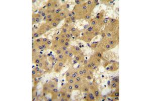 APOF antibody immunohistochemistry analysis in formalin fixed and paraffin embedded human hepatocarcinoma followed by peroxidase conjugation of the secondary antibody and DAB staining. (Apolipoprotein F Antikörper  (AA 111-138))