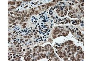 Immunohistochemical staining of paraffin-embedded Adenocarcinoma of colon tissue using anti-MCL1 mouse monoclonal antibody. (MCL-1 Antikörper)
