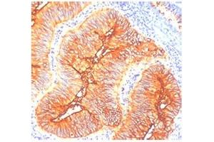 IHC staining of human colon cancer with TAG-72 antibody (TAG-72 Antikörper)