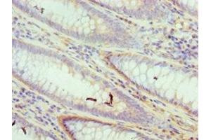 Immunohistochemistry of paraffin-embedded human colon cancer using ABIN7150176 at dilution of 1:100