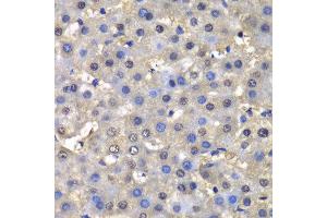 Immunohistochemistry of paraffin-embedded human liver injury using DHFR antibody at dilution of 1:100 (400x lens). (Dihydrofolate Reductase Antikörper)