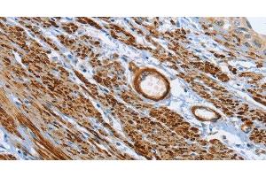Immunohistochemistry of paraffin-embedded Human cervical cancer tissue using SHROOM2 Polyclonal Antibody at dilution 1:50 (SHROOM2 Antikörper)