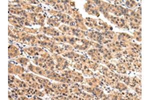 The image on the left is immunohistochemistry of paraffin-embedded Human liver cancer tissue using ABIN7128081(VIL1 Antibody) at dilution 1/30, on the right is treated with fusion protein.