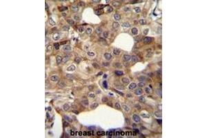 CCNI2 Antibody (Center) immunohistochemistry analysis in formalin fixed and paraffin embedded human breast carcinoma followed by peroxidase conjugation of the secondary antibody and DAB staining. (CCNI2 Antikörper  (Middle Region))