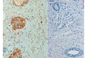 Immunohistochemistry of Rabbit anti STAT6 pY641 Antibody in human breast carcinoma pH 9(left) with negative control (right) Tissue: Human breast carcinoma (STAT6 Antikörper  (Internal Region, pTyr641))