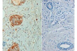 Immunohistochemistry of Rabbit anti STAT6 pY641 Antibody in human breast carcinoma pH 9(left) with negative control (right) Tissue: Human breast carcinoma (STAT6 Antikörper  (pTyr641))