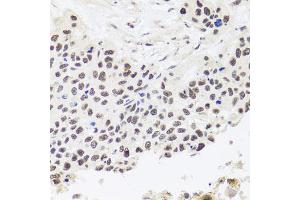 Immunohistochemistry of paraffin-embedded human lung cancer using RPP30 antibody. (RPP30 Antikörper)