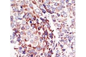 IHC analysis of FFPE human hepatocarcinoma tissue stained with the TIE2 antibody (TEK Antikörper  (AA 758-789))