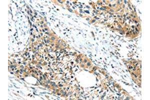 The image on the left is immunohistochemistry of paraffin-embedded Human esophagus cancer tissue using ABIN7190846(GPR15 Antibody) at dilution 1/20, on the right is treated with synthetic peptide. (GPR15 Antikörper)