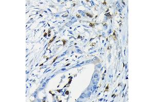 Immunohistochemistry of paraffin-embedded human colon carcinoma using NF Rabbit pAb (ABIN6130595, ABIN6144558, ABIN6144559 and ABIN6222368) at dilution of 1:200 (40x lens). (NFATC3 Antikörper  (AA 1-290))