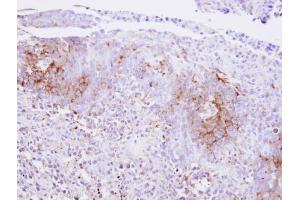 IHC-P Image Immunohistochemical analysis of paraffin-embedded SAS xenograft , using Calcium Sensing Receptor, antibody at 1:500 dilution. (CASR Antikörper)
