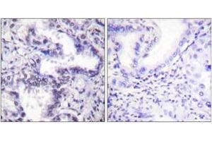 Immunohistochemistry analysis of paraffin-embedded human lung carcinoma, using Ku80 (Phospho-Thr714) Antibody. (XRCC5 Antikörper  (pThr714))