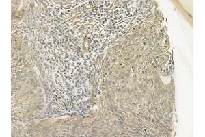 ABIN6266280 and ABIN6277107 at 1/100 staining human cervical carcinoma by IHC-P.