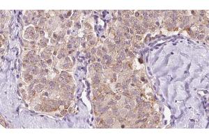 ABIN6273351 at 1/100 staining Human thyroid cancer tissue by IHC-P. (ZFYVE16 Antikörper  (C-Term))