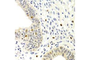 Immunohistochemistry of paraffin-embedded human uterine cancer using GEMIN2 Antibody. (SIP1 Antikörper)