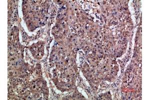 Immunohistochemical analysis of paraffin-embedded human-lung-cancer, antibody was diluted at 1:200 (IFNAR1 Antikörper  (AA 300-350))