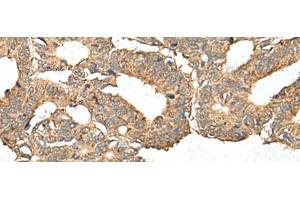 Immunohistochemistry of paraffin-embedded Human colorectal cancer tissue using AHNAK Polyclonal Antibody at dilution of 1:50(x200) (AHNAK Antikörper)