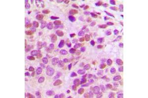 Immunohistochemical analysis of GATA3 staining in human breast cancer formalin fixed paraffin embedded tissue section. (GATA3 Antikörper  (Center))